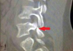 Опубликован рентгеновский снимок перелома Неймара. ЧМ-2014 (ФОТО)